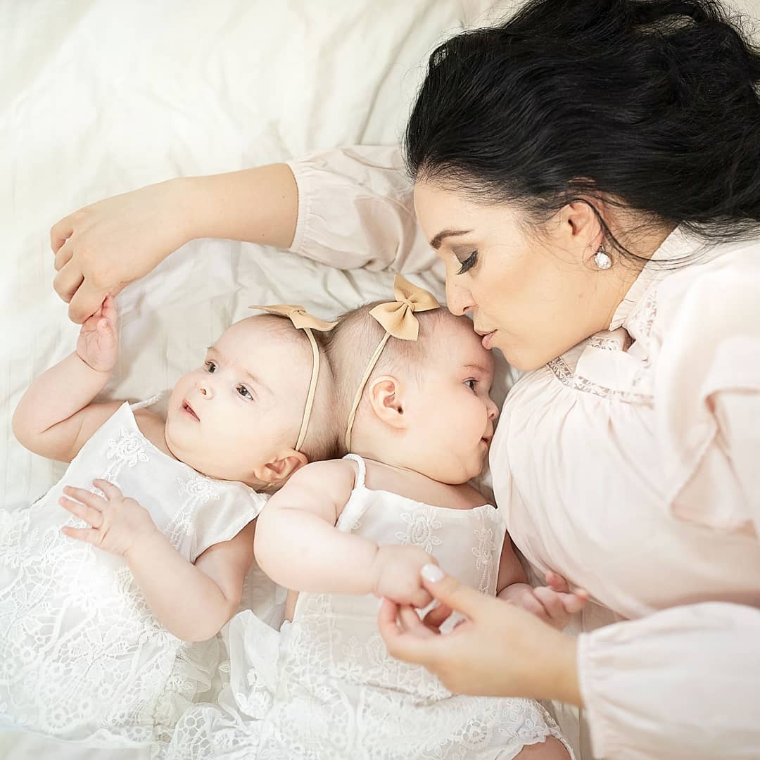 Українка народила зрощених близнюків, яким давали мінімальні шанси вижити: як вони виглядають зараз