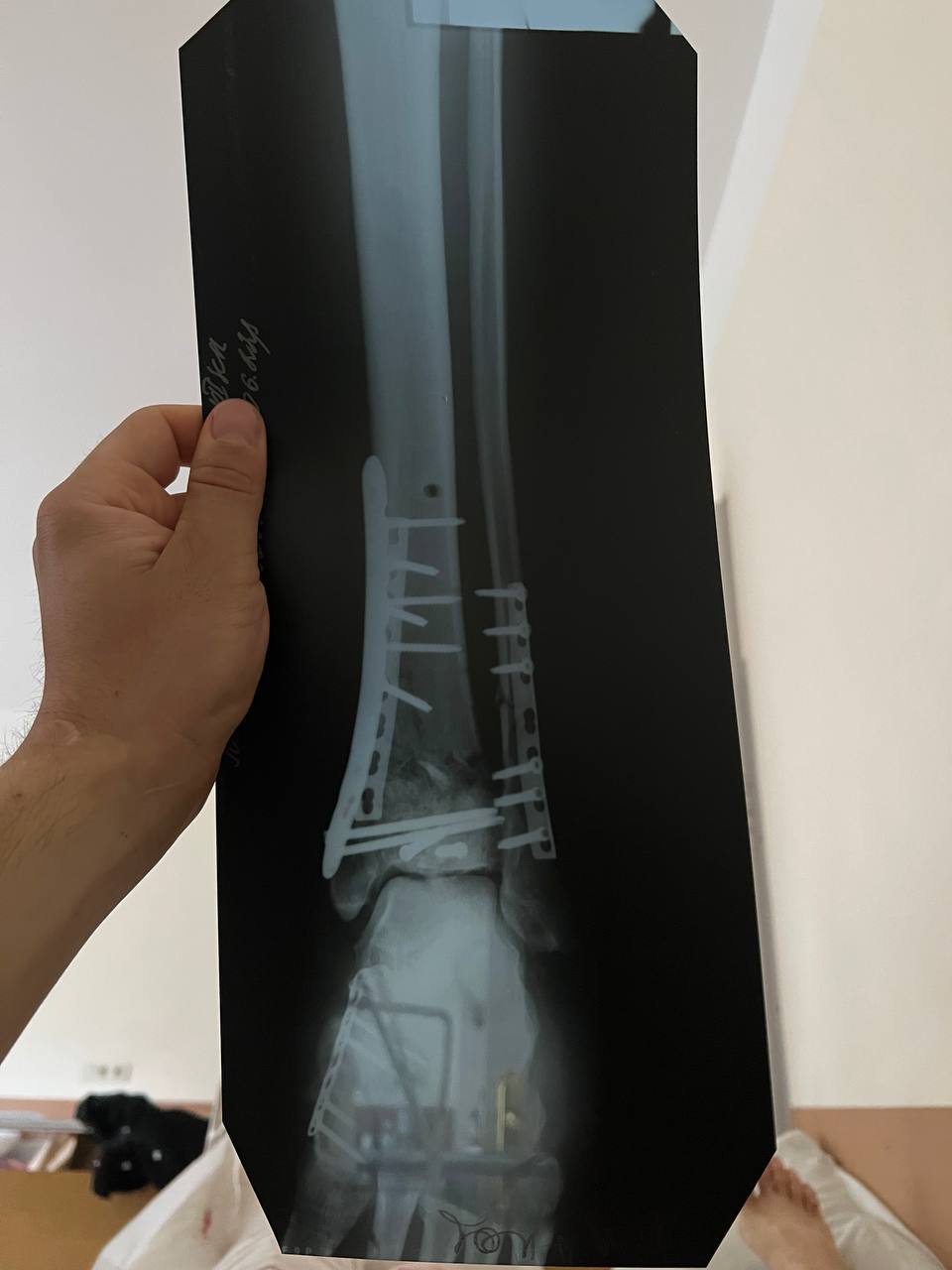 'Russia wants us to leave our country and forget our history' - Ukrainian military volunteer miraculously survives injury