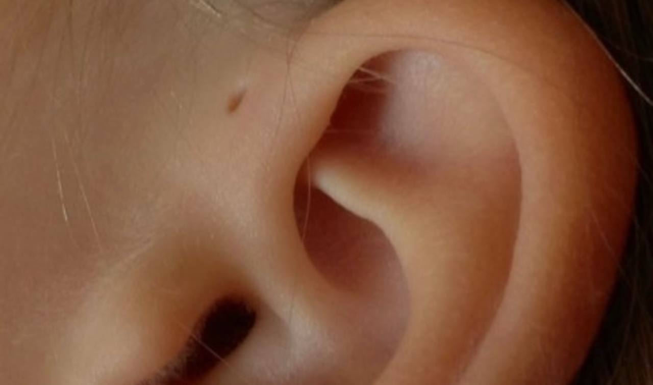 "Дірочка біля вуха": дерматолог назвала стан, який виникає в 1% людей у світі