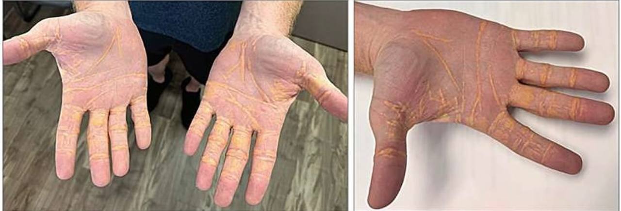 Ця популярна у мережі дієта сильно збільшує холестерин в організмі: всі деталі