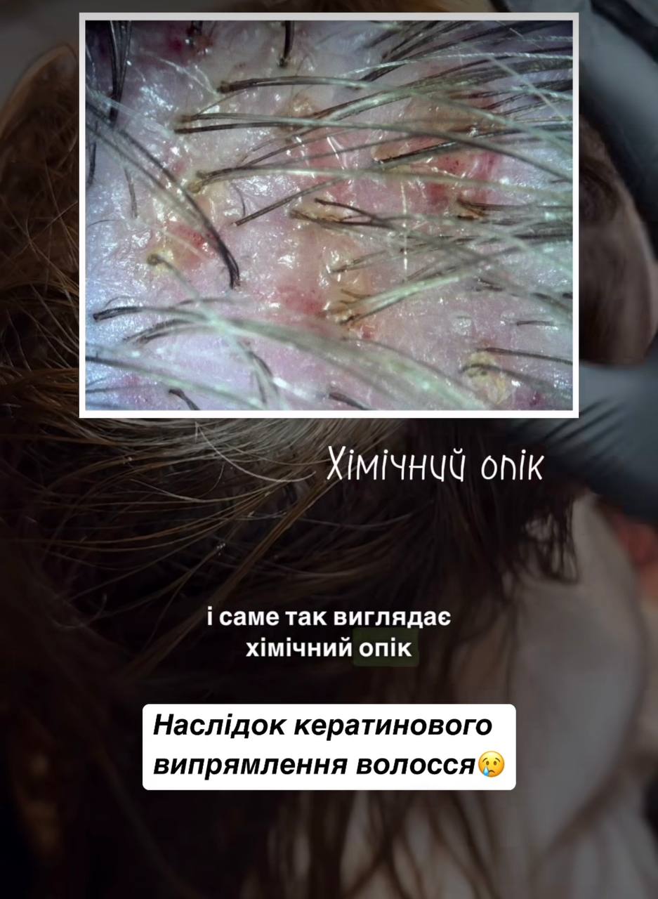Сильний опік і випадіння. Трихолог показала наслідок кератинового випрямлення волосся (фото)