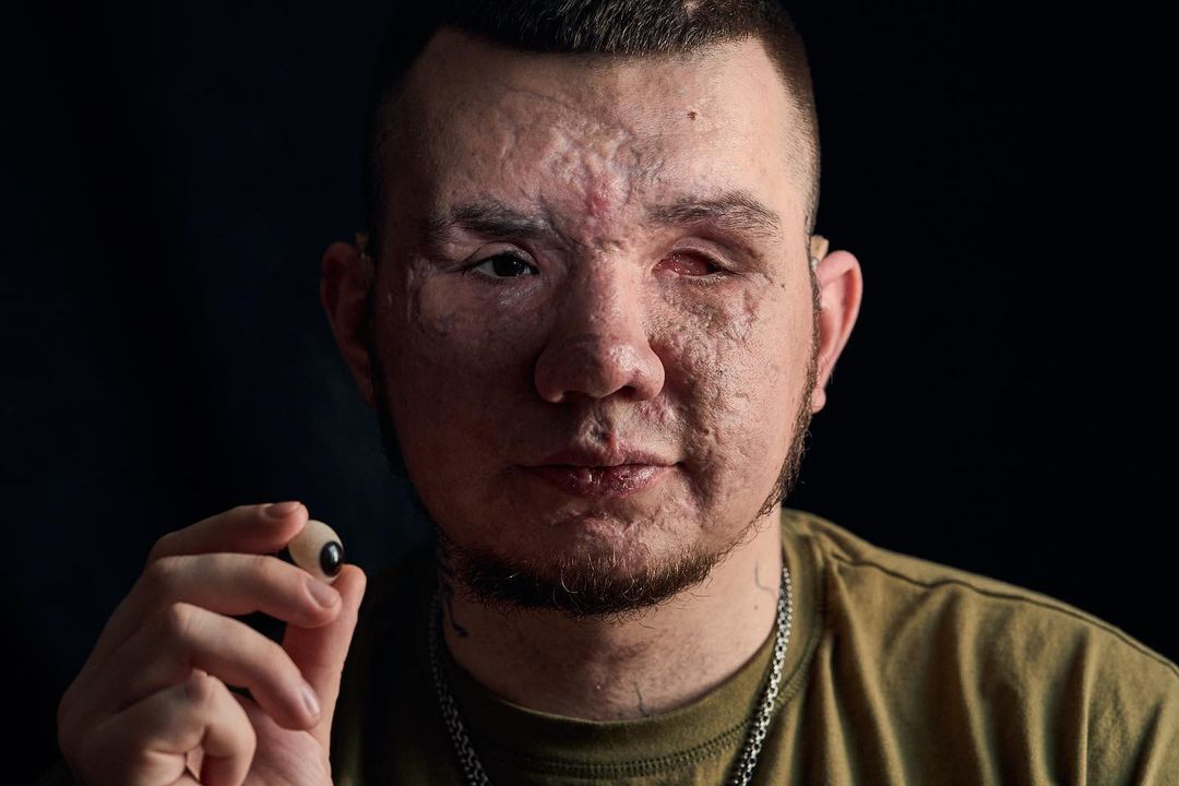 &quot;Невеста поддерживает с первых дней&quot;. Чувственная история Влада, потерявшего глаза, защищая Украину