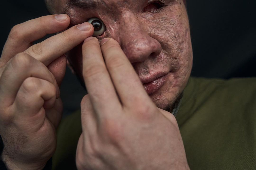 &quot;Невеста поддерживает с первых дней&quot;. Чувственная история Влада, потерявшего глаза, защищая Украину