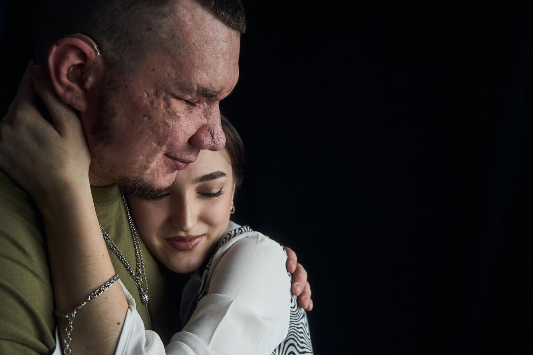 &quot;Невеста поддерживает с первых дней&quot;. Чувственная история Влада, потерявшего глаза, защищая Украину