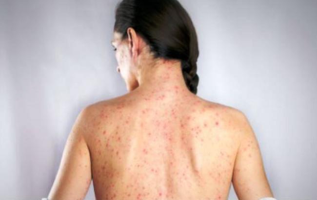 В Польше обнаружили корь у четырех граждан Украины