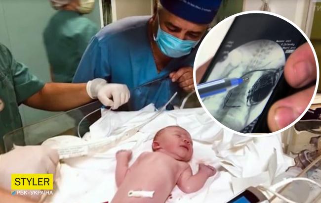 В Україні провели унікальну операцію новонародженому (відео)