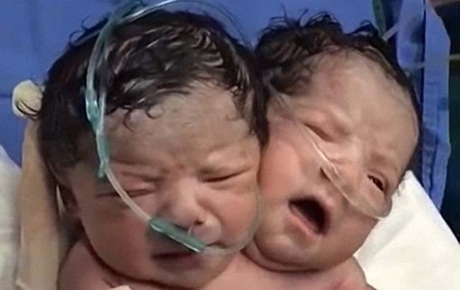 В Мексике родился младенец c двумя головами