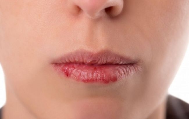 Три простых шага, чтобы никогда больше не иметь трещин на губах