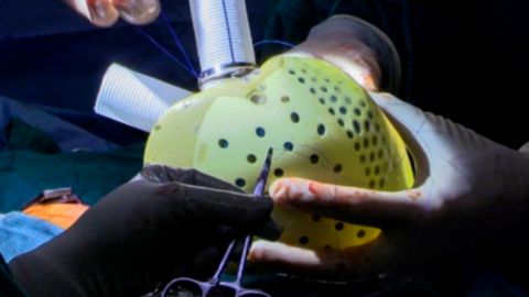 В США трансплантировали полностью искусственное четырехкамерное сердце