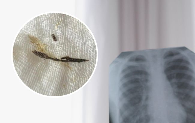 Полтора года не могли поставить диагноз: во Львове в бронхах мальчика нашли хвойную веточку