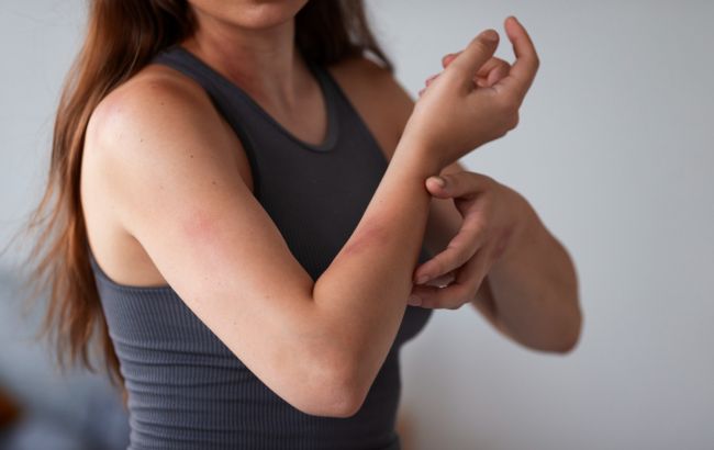 Как быстро избавиться от синяков: названы эффективные способы