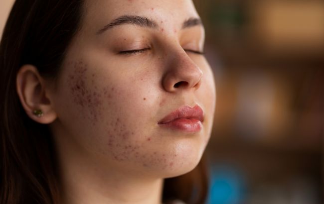 Чи справді молоко може провокувати акне? Косметолог дала чітку відповідь