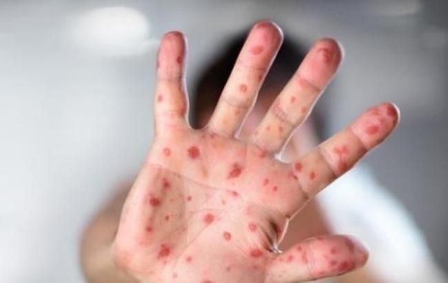 В Пакистане бушует эпидемия лихорадки, пострадали 20 тыс. человек
