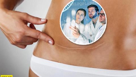 Кесарево сечение: ученые обнаружили еще одно последствие этой операции