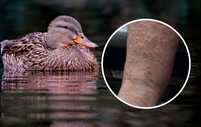 Врачи показали, какую болезнь можно подцепить из водоемов с утками