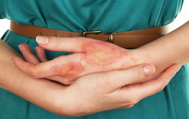 Як швидко допомогти при опіках: медики дали чіткий алгоритм дій