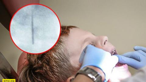 В Ужгороді стоматолог залишив у дитини в горлі голку: всі подробиці інциденту