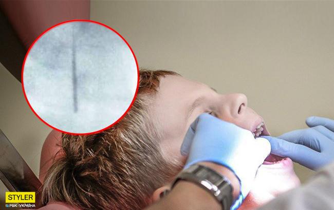 В Ужгороде стоматолог оставил у ребенка в горле иглу: все подробности инцидента