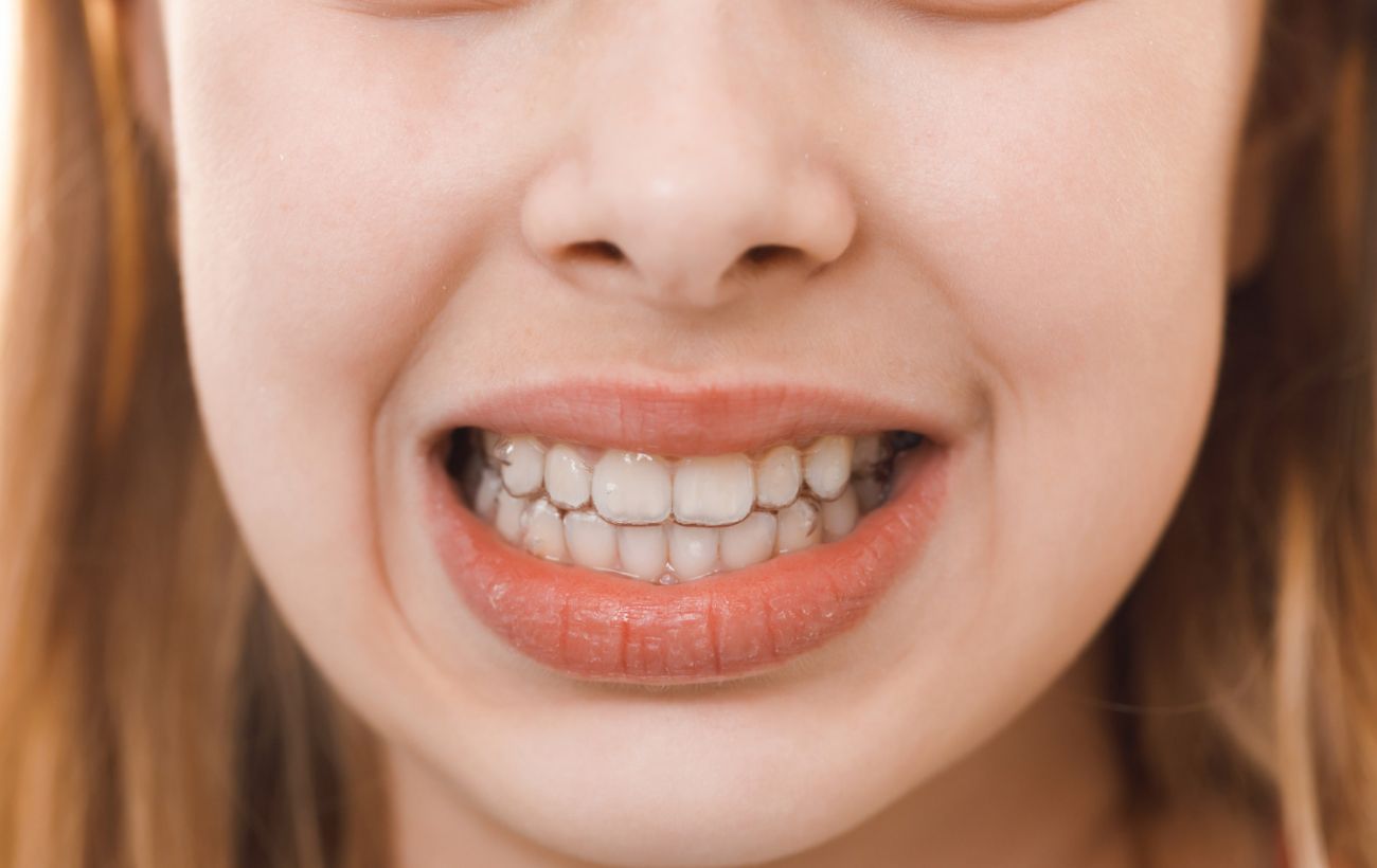 Чому зуби стають кривими: 5 причин, про які має знати кожен