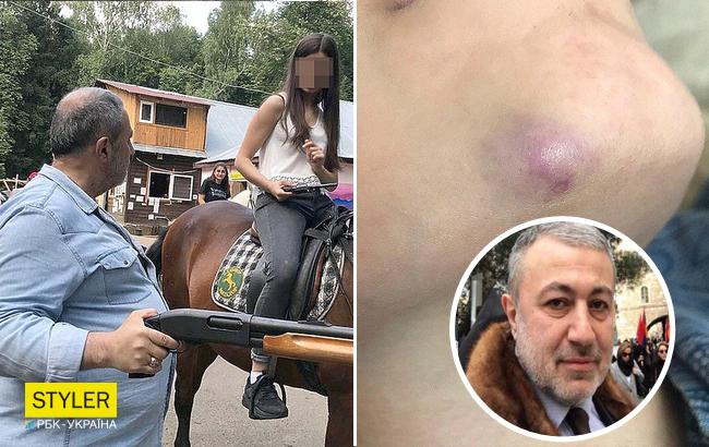 "Девочки прошли через настоящий ад": в сети появились фото сестер Хачатурян с побоями