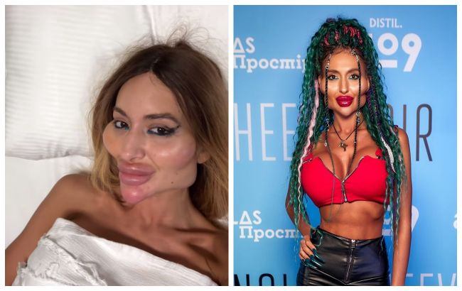 "Кожа болтается": украинка с самыми большими скулами похудела на 12 кг и перенесла еще одну "пластику"