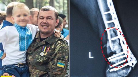 "Прочитайте історію боротьби Сергія": українців просять допомогти пораненому ветерану АТО