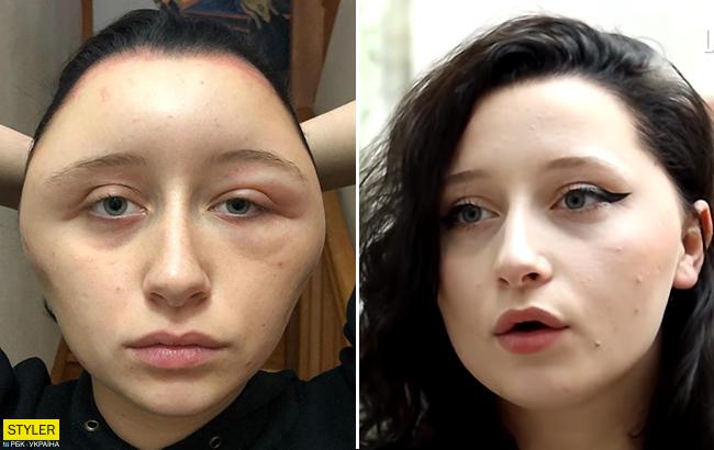 Голову роздуло: дівчина ледь не померла після фарбування волосся