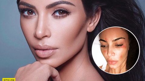 Ким Кардашьян заявила о страшной болезни (фото)