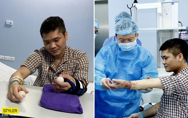 Хірурги провели першу в світі пересадку руки від живого донора