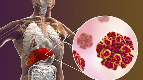 Спалах гепатиту А в Україні: як не стати жертвою небезпечного вірусу