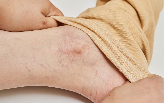 Не пропустіть їх. Ці ознаки на ногах можуть вказувати на виникнення раку