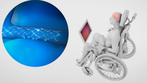 Обгонит Илона Маска: компания Synchron в этом году опробует мозговые импланты