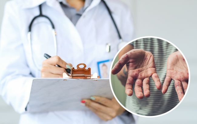 Из-за ветрянки могла потерять легкое: во Львове у ребенка обнаружили тяжелое осложнение