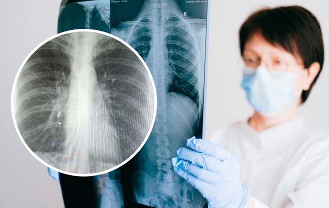 Прожила із зубом у бронхах понад півроку: лікарям у Львові вдалося врятувати жінку