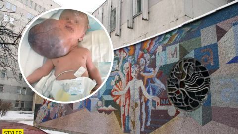 Была вдвое больше головы: в Украине врачи впервые удалили гигантскую опухоль у младенца