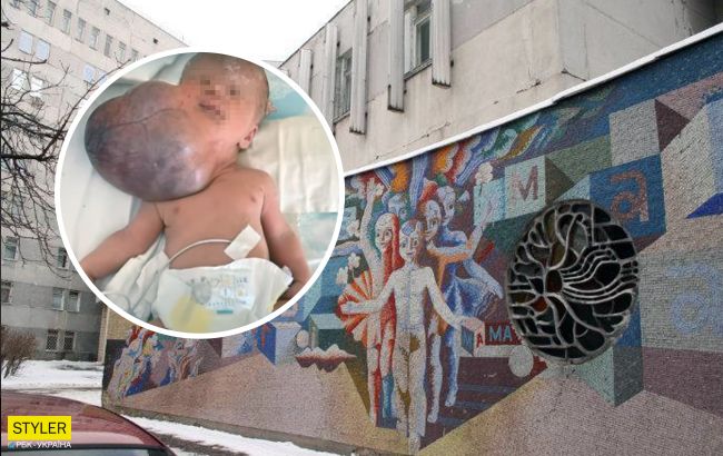 Була вдвічі більша за голову: в Україні лікарі вперше видалили гігантську пухлину у немовляти