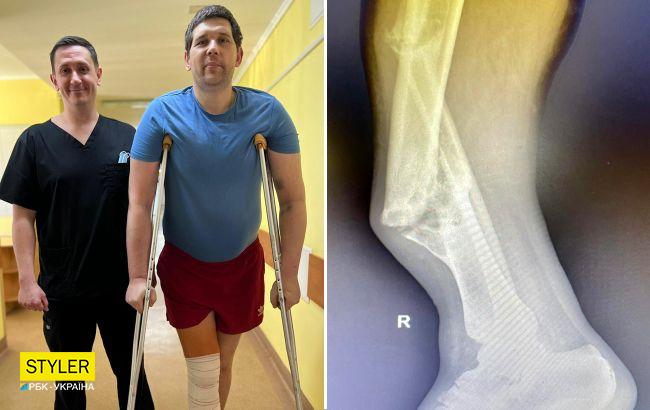 Львівські лікарі прооперували пацієнта зі Слов'янська, у якого нога згиналася в різні боки