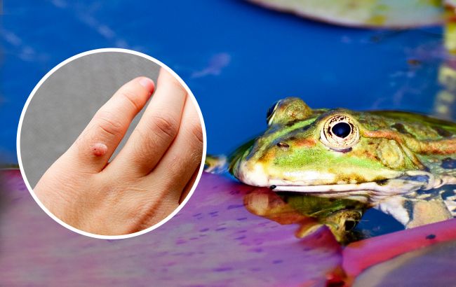 Дерматолог рассказала, правда ли бородавки появляются от контакта с жабами