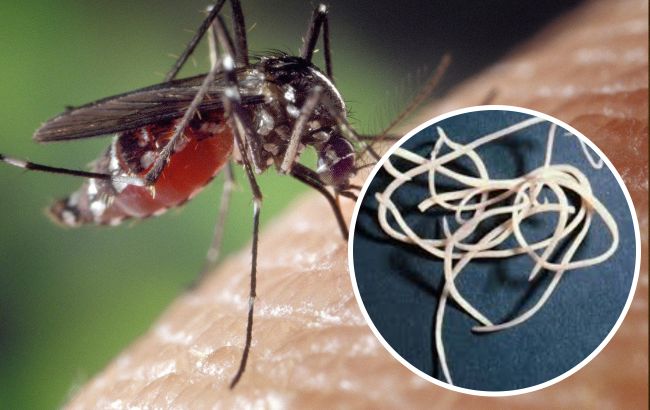 В Кривом Рогу у женщины после укуса комара вырос под кожей 11-сантиметровый гельминт