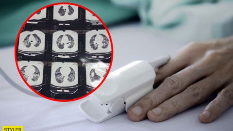 Не восстанавливаются никогда: врач сделала заявление о легких и COVID-19