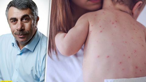 Вилікувати майже неможливо: Комаровський розповів про неприємне захворювання шкіри