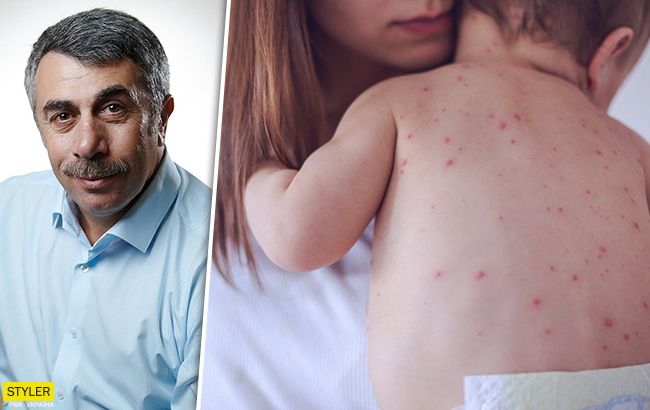 Вылечить почти невозможно: Комаровский рассказал о неприятном заболевании кожи
