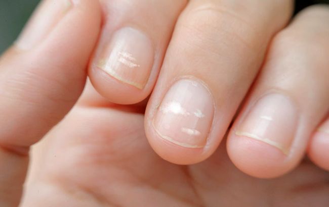 Лікарка розповіла, що означають білі плями на нігтях