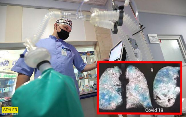 Українські лікарі показали фото легенів хворого на COVID-19: різниця вражає