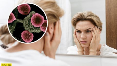 Цей симптом онкології проявляється на обличчі і шиї: будьте обережні