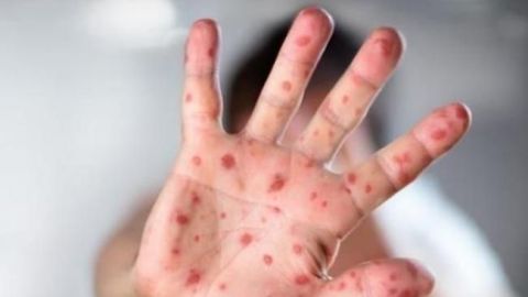 У Чернівецькому університеті стався спалах кору