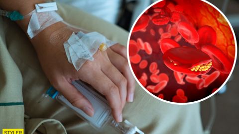 Лікар розказав, у кого можуть утворитися тромби та, чи впливає на це генетика