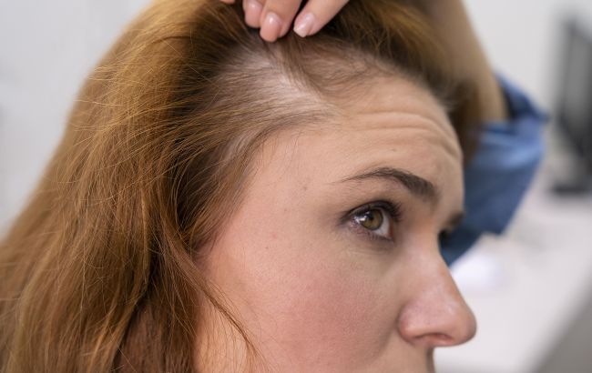 Что делать, когда сильно выпадают волосы: топ-5 советов