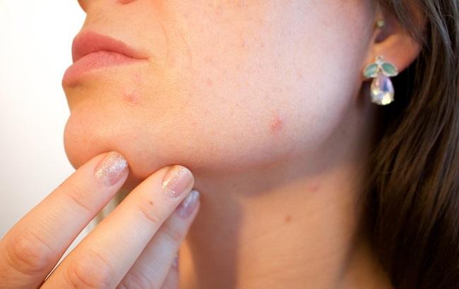 "Вы удивитесь": дерматолог назвала неожиданную причину появления прыщей на лице