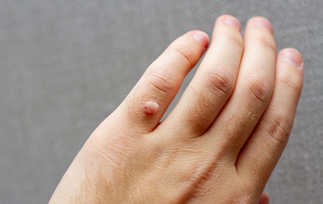 Бородавки - это вирус. Врач рассказала, кто в зоне риска и как их не подцепить